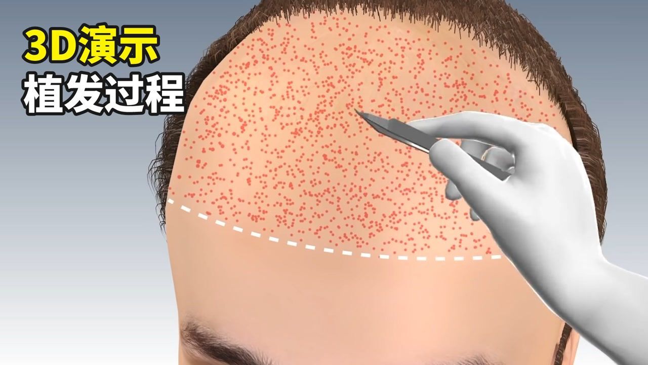 史上最全动画短片_植发是如何进行，动画3D演示全过程，1分钟带你了解植发_高清1080P在线观看平台_腾讯视频