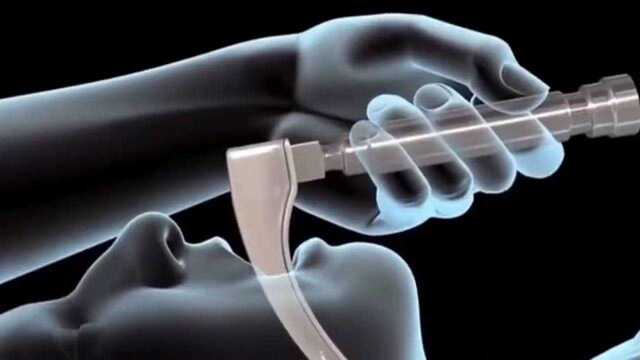 3D科普气管插管如何操作,辅助管被直接插进体内,看着都觉得恐怖!