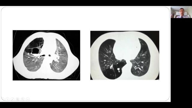 先天性肺部发育异常的影像学诊断甘肃省妇幼保健院朱大林