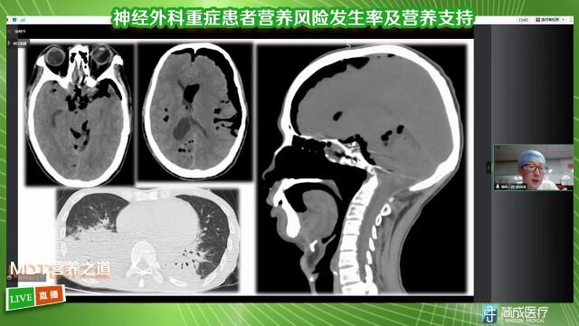 419神经外科重症患者营养风险发生率及营养支持