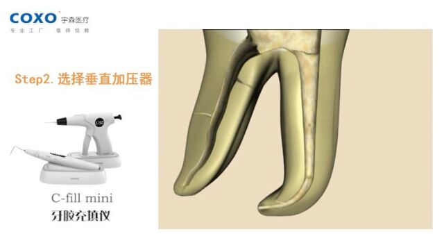 牙胶充填仪CFILL MINI l连续充波操作视频