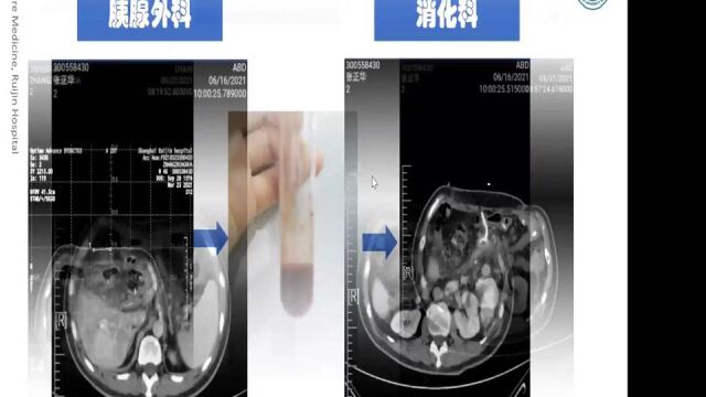 急性重症胰腺炎多学科协作综合诊疗