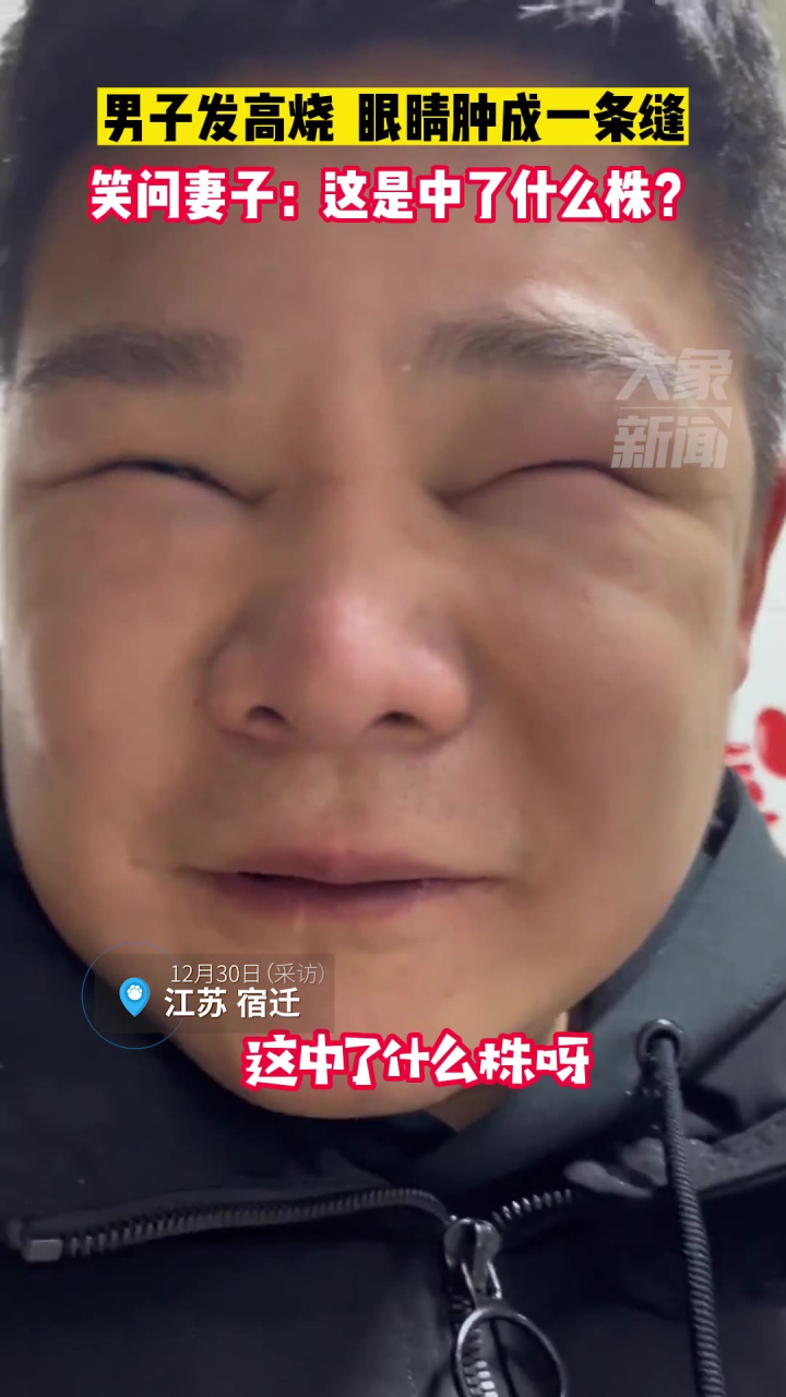男子发高烧,眼睛肿成一条缝