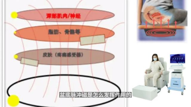 盆底脉冲磁是怎么发挥作用的?