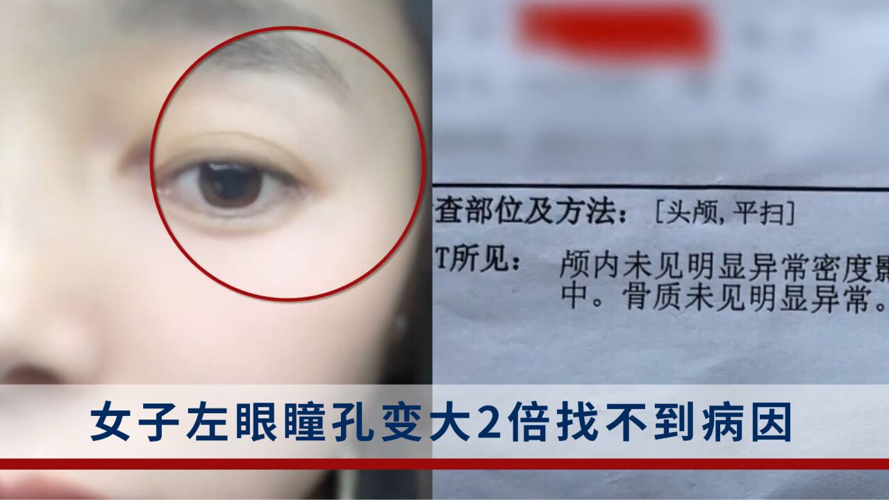 女子左眼瞳孔变大2倍找不到病因:白天不能出门,很畏光