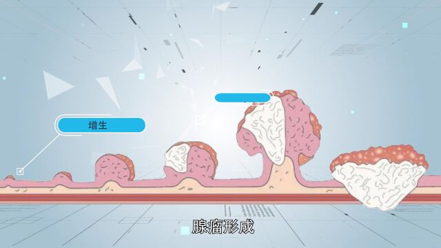 成都博仕胃肠病医院:息肉是怎么回事?