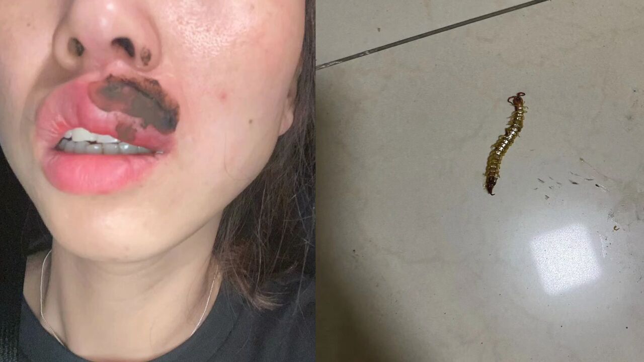 女子睡梦中被蜈蚣咬醒成"香肠嘴"当事人:嘴巴麻木伴有胸闷