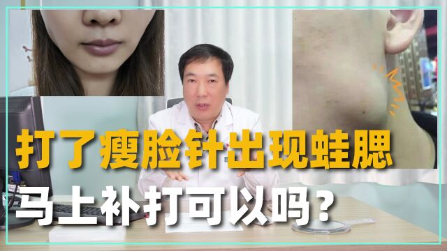 打了瘦脸针出现蛙腮,马上补打可以吗?