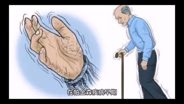 帕金森早期走路姿态