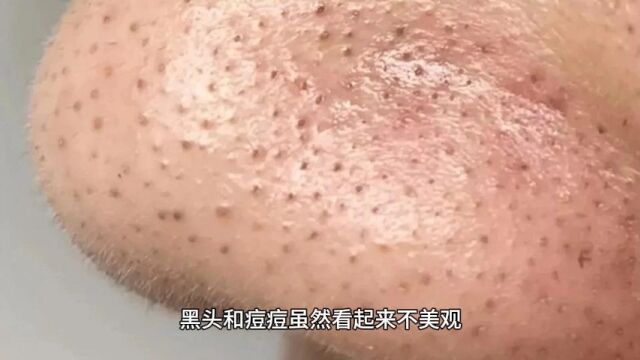 黑头和痘痘虽然看起来不美观,但是挤它们会让你更后悔