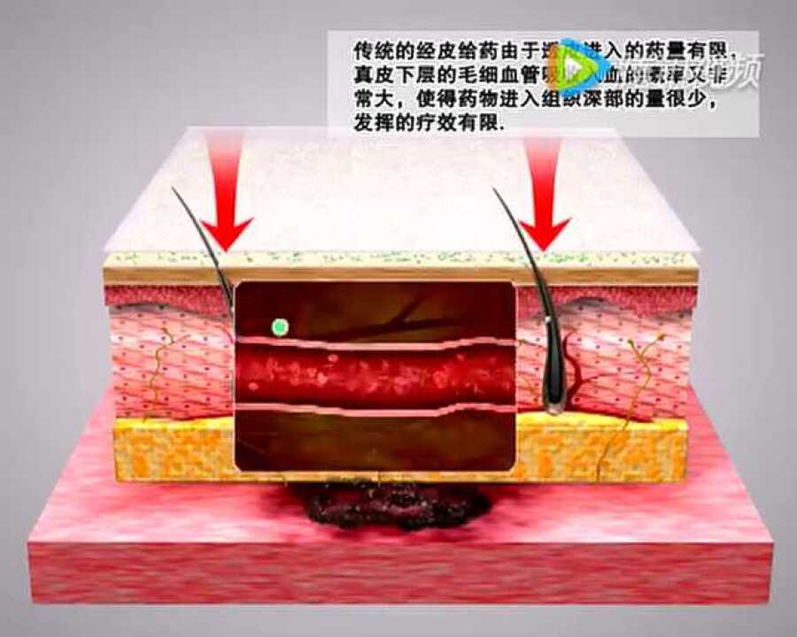 陈王TTS经皮给药技术动画介绍_高清1080P在线观看平台_腾讯视频