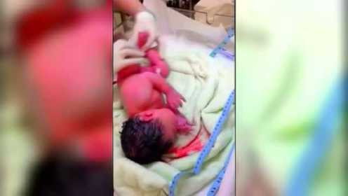 护士阿姨给刚出生的婴儿抽脐带血 宝宝好可爱！
