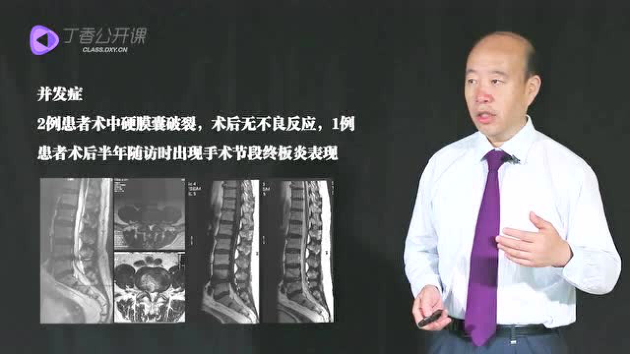 张西峰教授:经椎间孔入路脊柱内窥镜下360度减压治疗腰椎管狭窄_高清1080P在线观看平台_腾讯视频