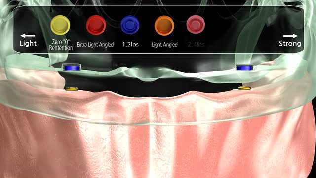 敦瑞特种植locator基台修复操作演示_腾讯视频