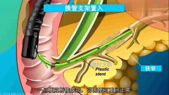 李双全专家工作室胆总管结石ercp手术演示视频