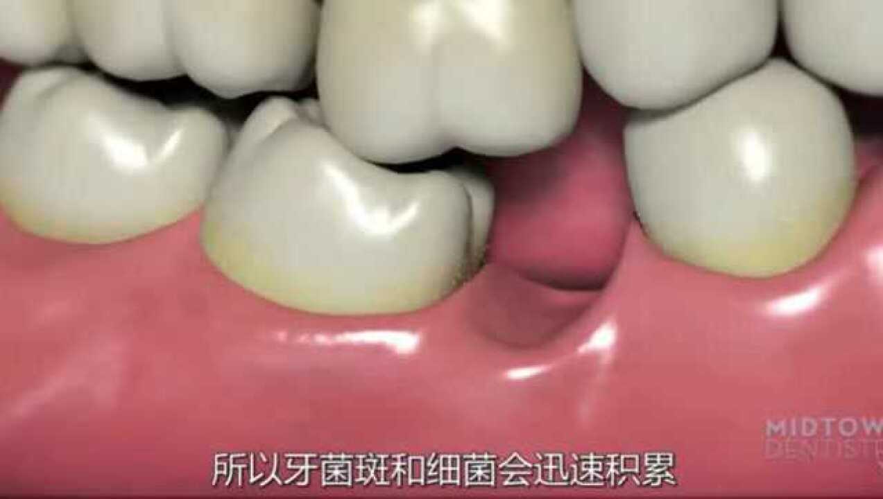 3D动画演示,缺牙的危害到底有多大?_高清1080P在线观看平台_腾讯视频