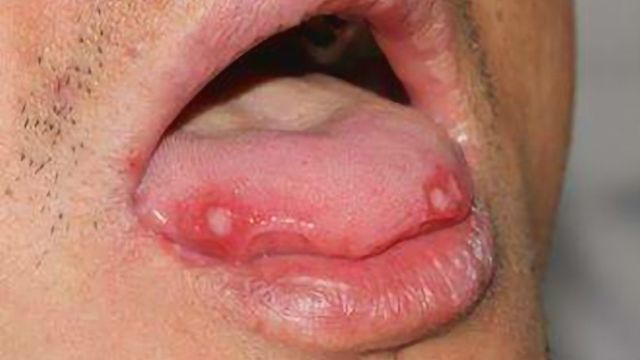 舌头起泡不止上火出现这3种情况要小心严重会出现口疮