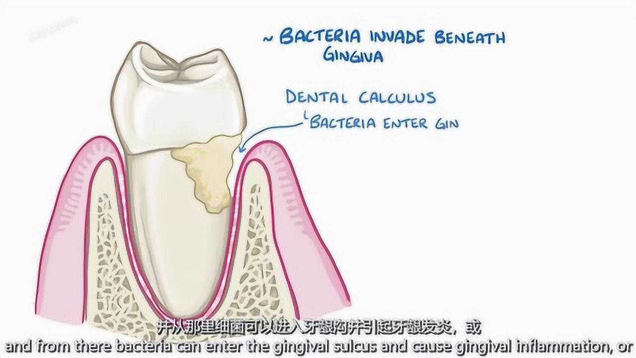 牙龈炎和牙周炎-导致症状诊断治疗病理_高清1080P在线观看平台_腾讯视频