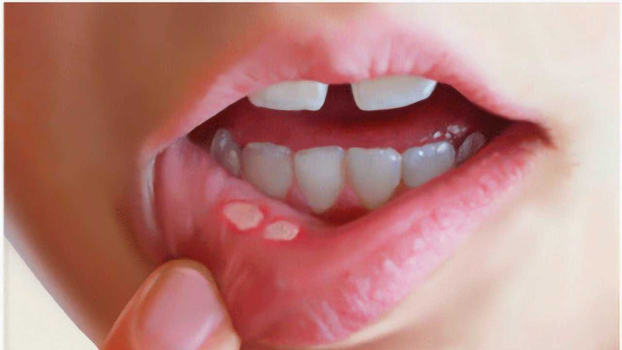 上火嘴里长口疮怎么办教你农村土偏方快速消除火泡简单实用