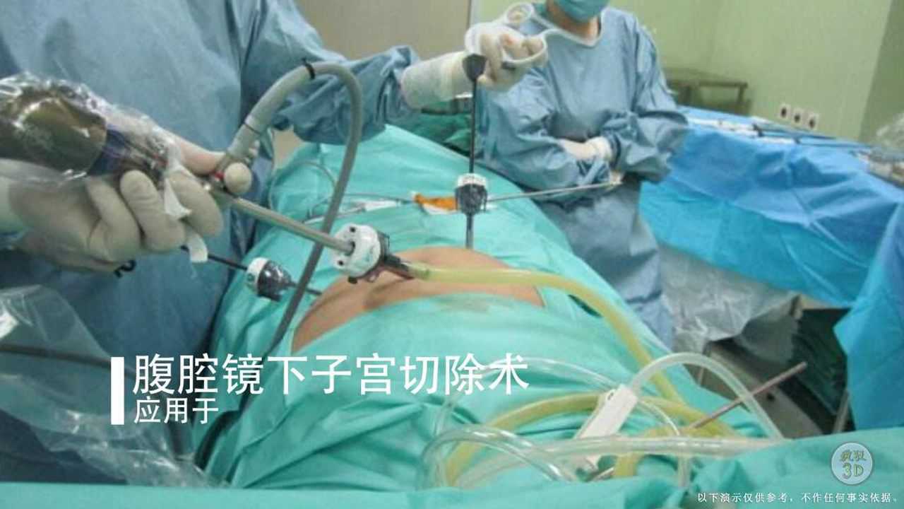 3D演示:腹腔镜子宫切除术过程,女同胞们,你对号入座了吗?_高清1080P在线观看平台_腾讯视频