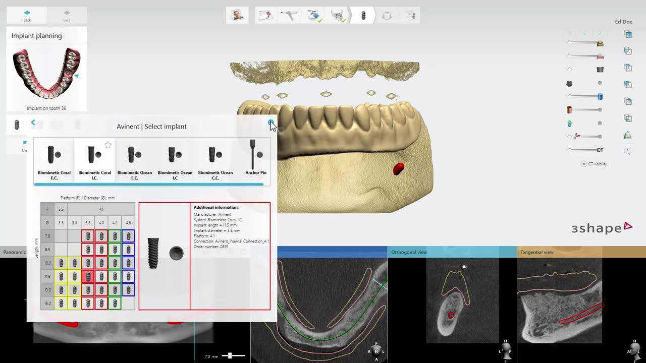 3shape implant planning