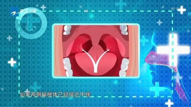 知识百科:宝妈知识库,扁桃体分三个分辨,出现第三种情况就要警惕