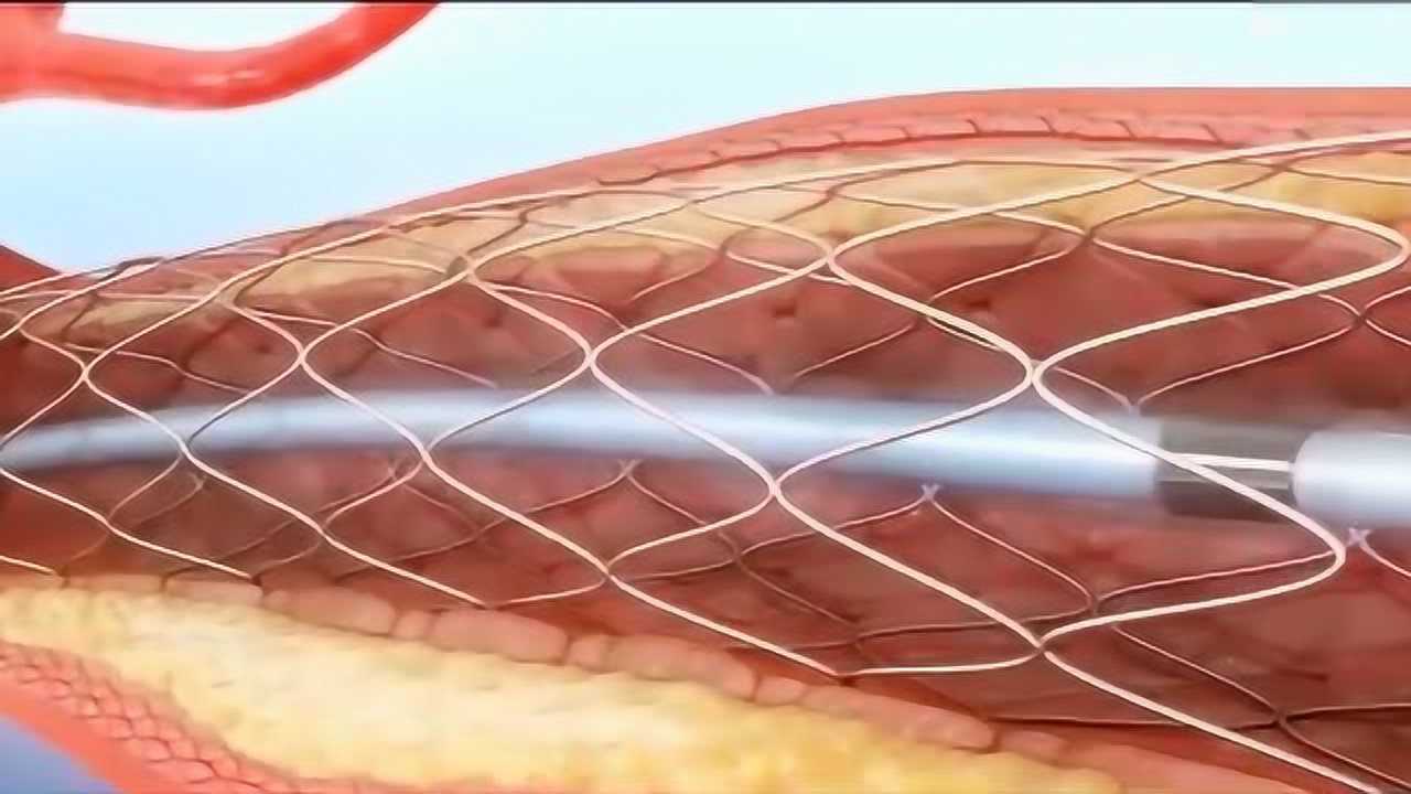 冠脉支架植入术pci3d动画展示