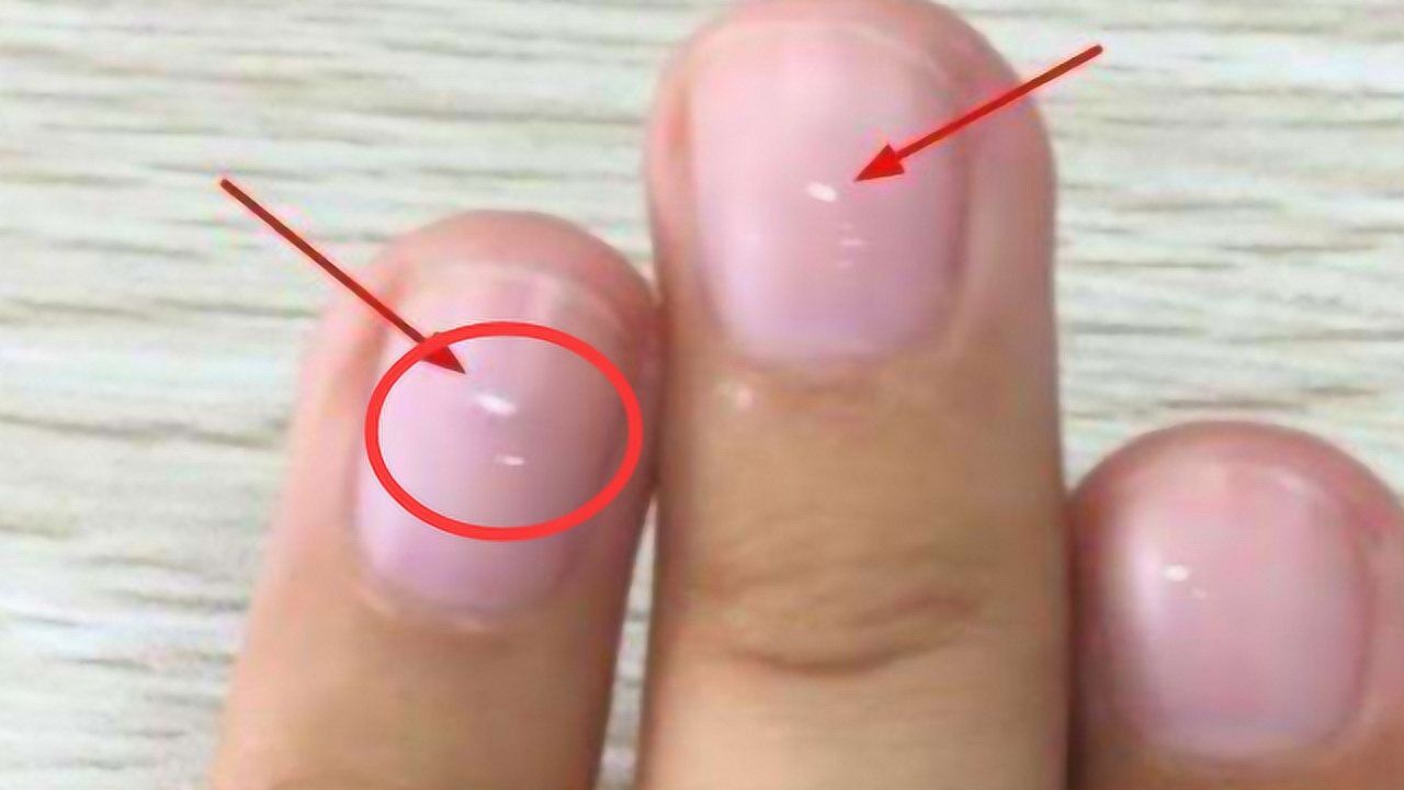 指甲上出现这种"竖纹",不用怀疑,肝癌来了,晚了医生也救不了你了