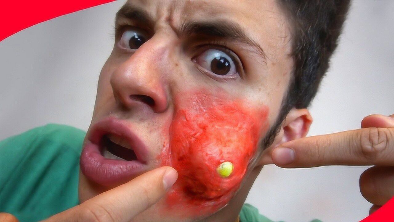 世界上最大的脓包怎么挤掉老外请朋友帮忙隔着屏幕都在吐