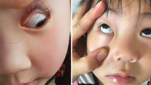 宝宝眼白上有不明黑斑吓坏爸妈 可能是这两种情况