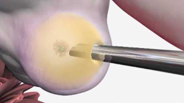 女性到底是怎么“取卵”的?医生说出全过程,看完汗毛直竖