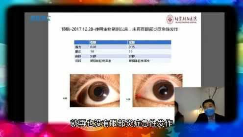 葡萄膜炎患者就医建议：合并眼病风湿病患者-陶勇教授