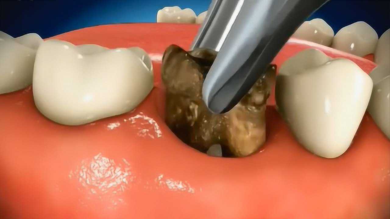 牙医是如何种植牙齿的把烂牙拔出的那一刻隔着屏幕都疼