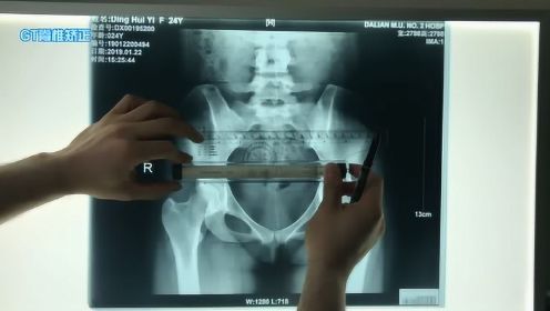 正骨整脊学习之《骨盆内外翻》在X光上的呈现