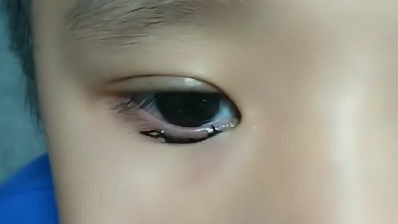 手术后眼睛舒服多了,终于摆脱了倒睫毛,倒睫毛的小孩真伤不起!