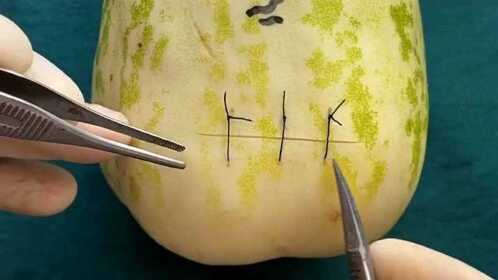 剖腹产拆线手术有多疼产科医生拿出工具的一刻一般男人都怂了