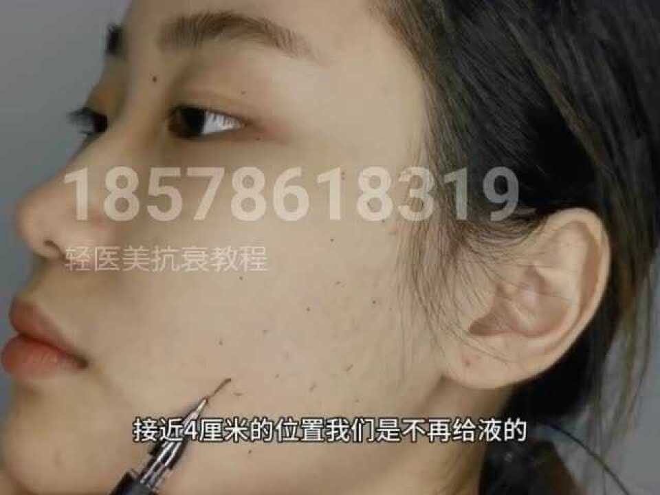 轻医美操作教程三线提升
