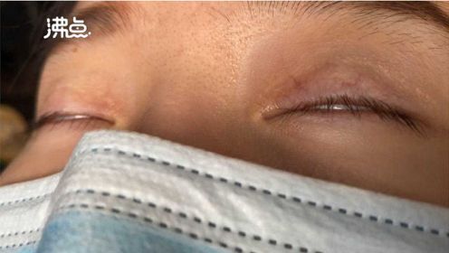 女子称协和医院割双眼皮致无法闭眼睡觉 医生：是修复手术 正常情况