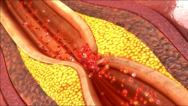 血管堵,身体先知,若出现3个异常迹象,说明你的血管“垃圾多”