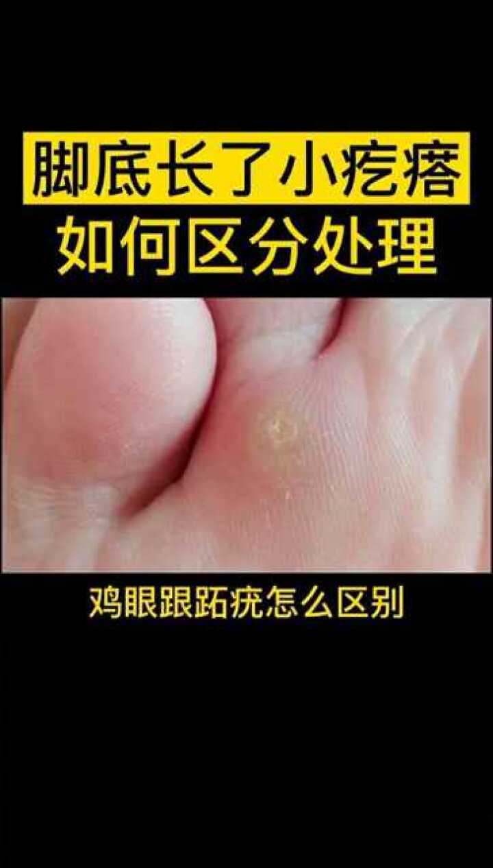 腳底長了小疙瘩有點疼,注意!#雞眼跟#蹠疣的區別,別再搞錯了#雞眼蹠疣