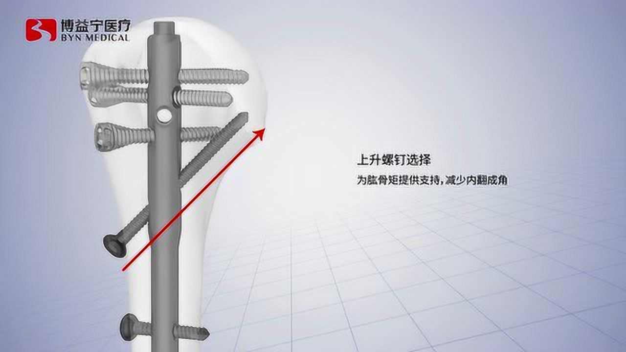 博益宁肱骨近端多维锁定髓内钉_腾讯视频