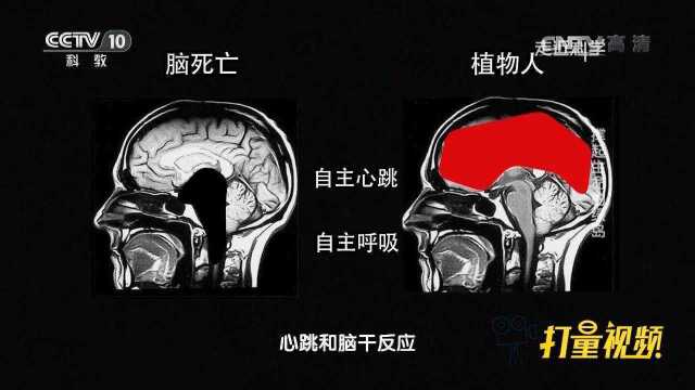 脑死亡病人为何还有呼吸,它与植物人有何差别?涨知识