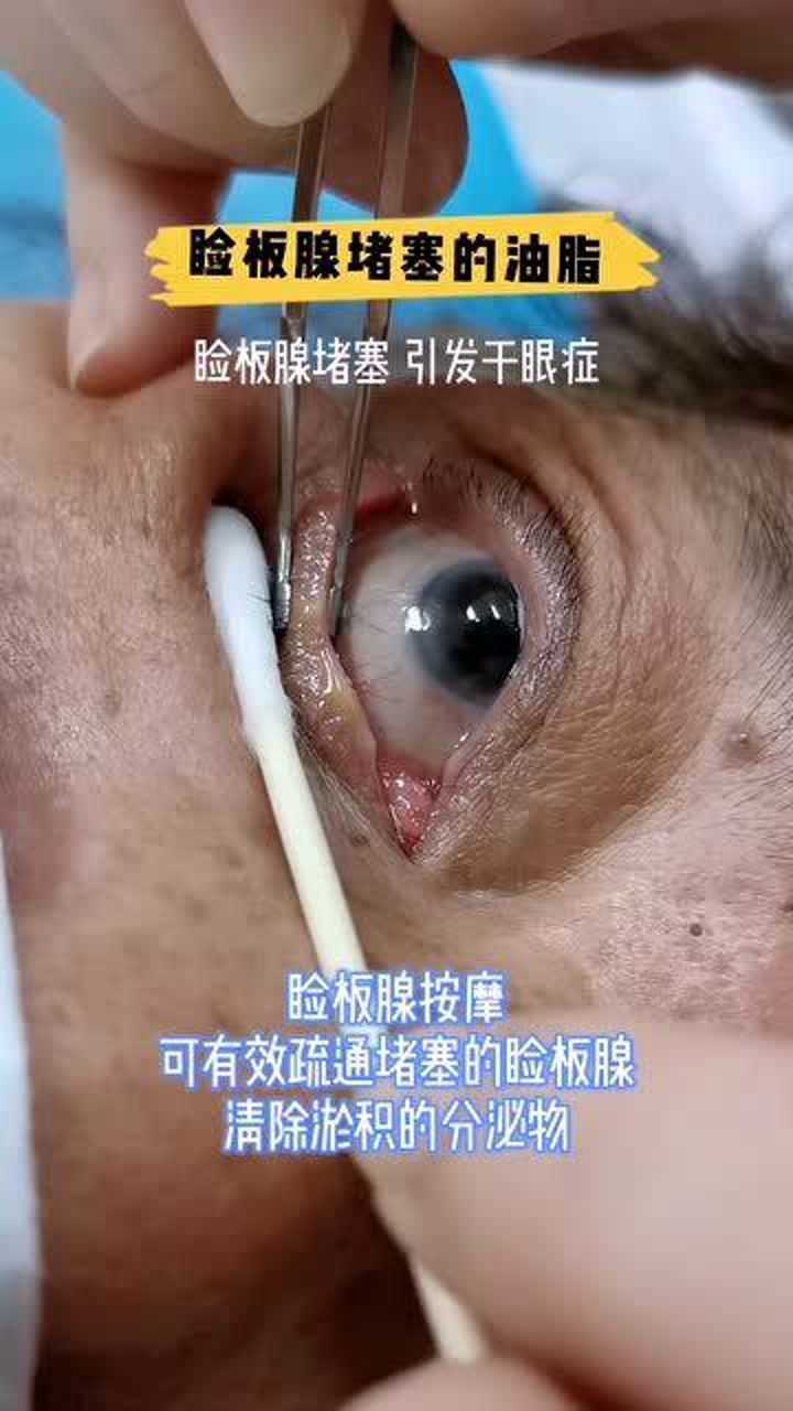 睑板腺滤泡图片