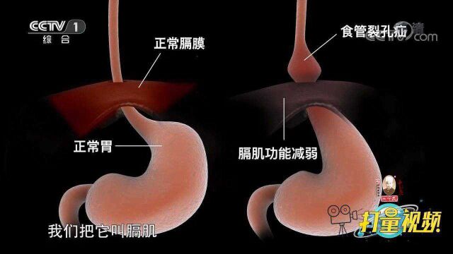 什么是食管裂孔疝?专家进行详细讲解,快来听听