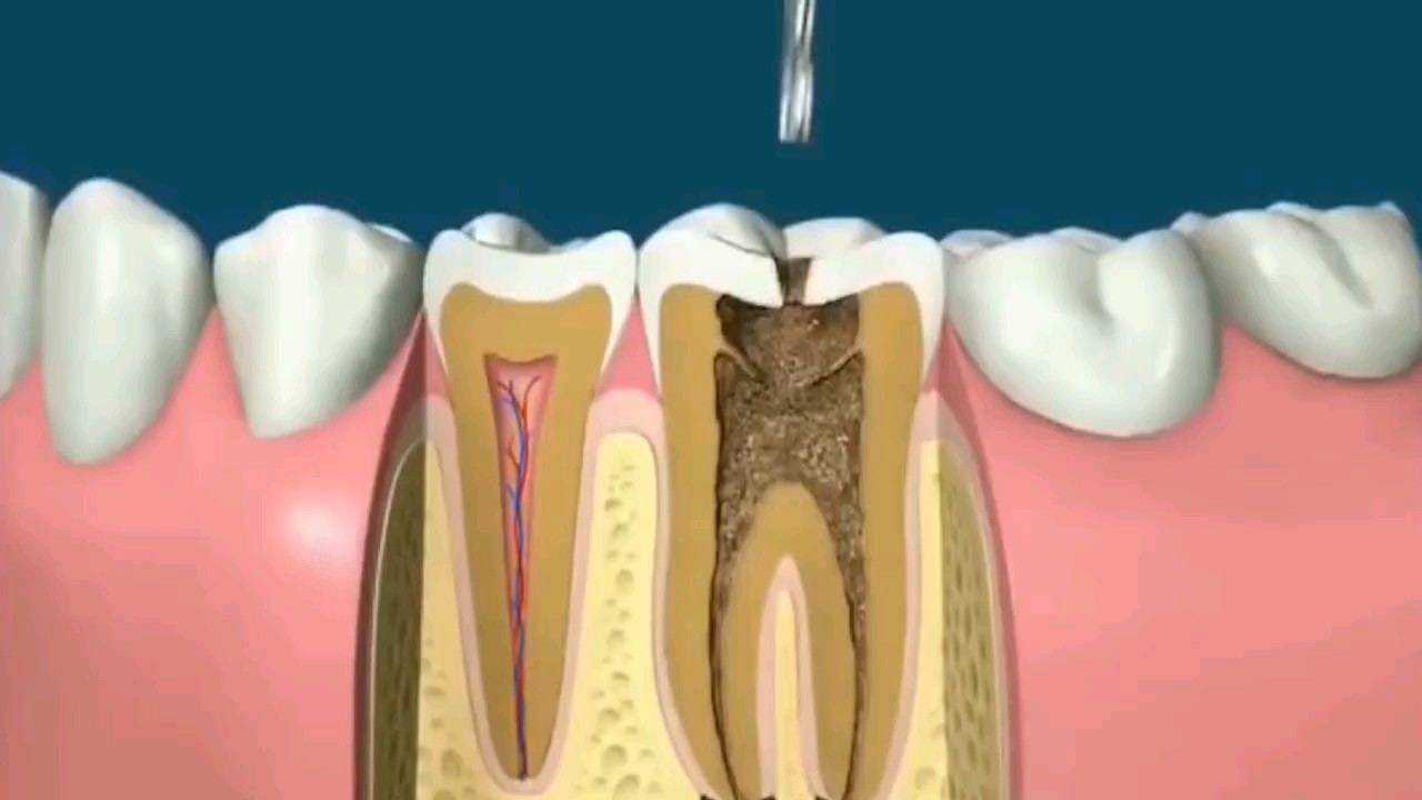 根管治疗过程动画