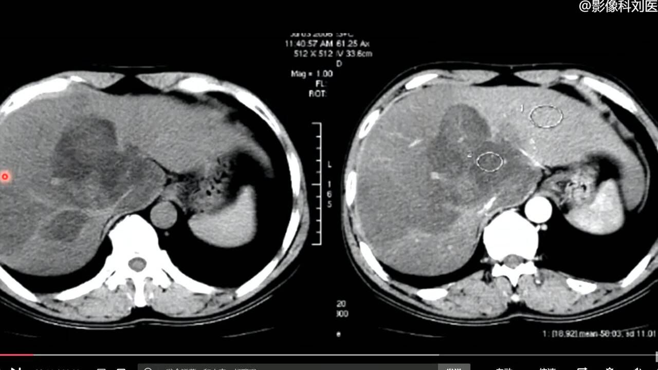 脂肪肝的ct表现