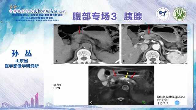 胰腺导管内肿瘤影像诊断和鉴别诊断山东医学影像学研究所孙丛