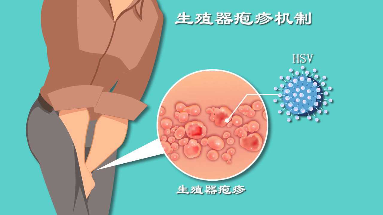 私处反复疱疹、溃烂？解密生殖器疱疹症状背后的真实原因，超赞！_高清