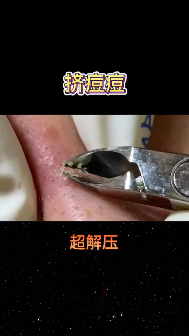 超解压拔黑头！密集恐惧症患者慎看！_高清