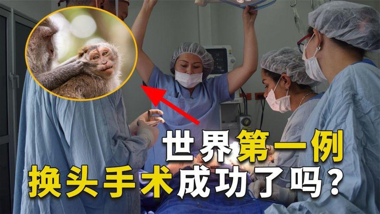 进行世界首例人体换头手术的人,结果怎么样?重获新生还是毁灭?
